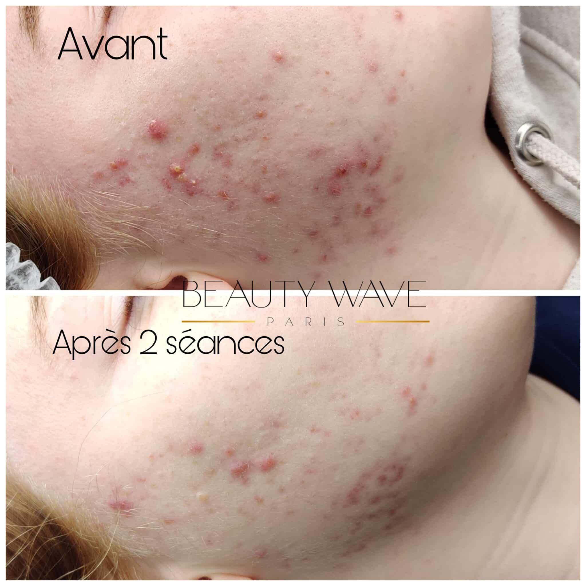 institut beauté Nice Beauty Wave soins du visage pour atténuer les tâches brunes et les boutons